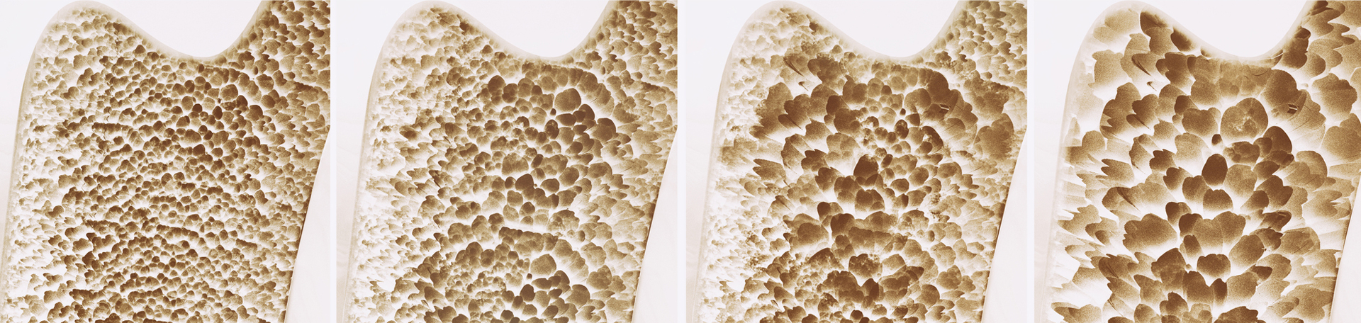 West Des Moines osteoporosis nutrition help with chondroitin sulfate